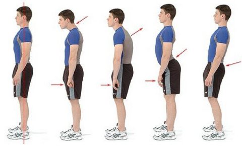 Duruş Bozuklukları